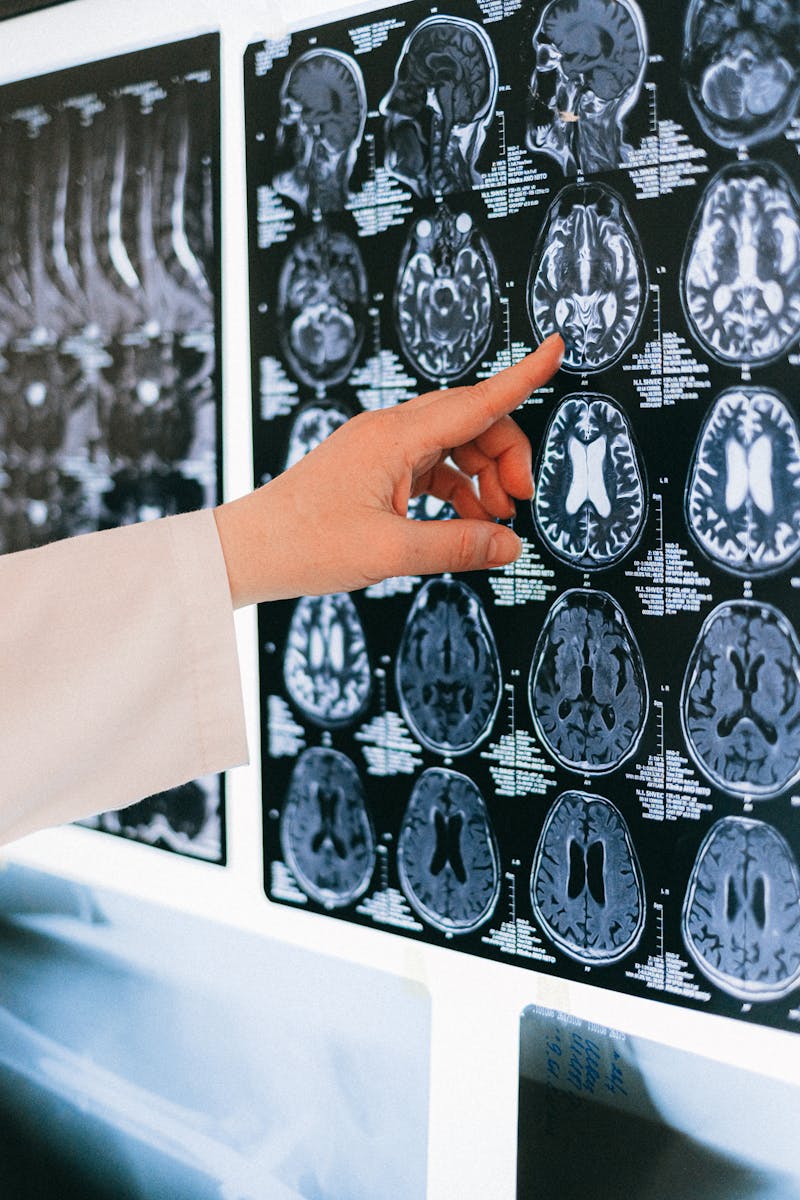 AI in Medical Diagnosis