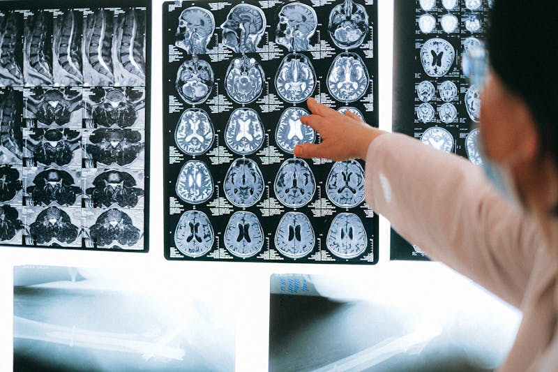 Stroke Diagnosis & Neurology Tech